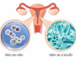 cac-dau-hieu-thuong-gap-cua-chi-em-khi-bi-viem-nhiem-phu-khoa